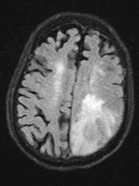 File:Brain abscess with dual rim sign (Radiopaedia 87566-103938 Axial FLAIR 17).jpg
