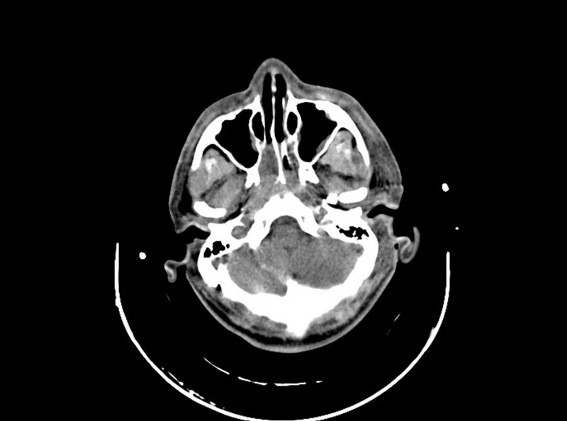 File:Brain injury by firearm projectile (Radiopaedia 82068-96087 B 53).jpg