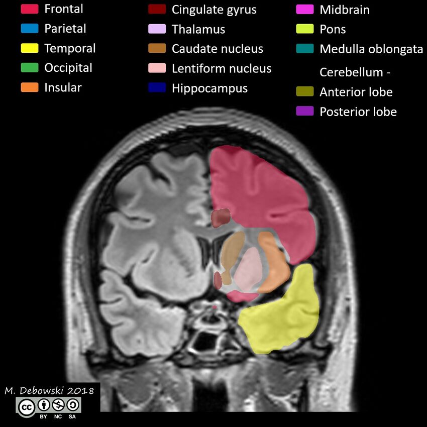 Brain lobes - annotated MRI (Radiopaedia 61691-69700 Coronal 26).JPG