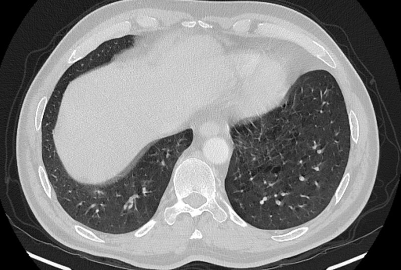 File:Brain metastases - lung cancer primary (Radiopaedia 75060-86116 Axial lung window 49).jpg
