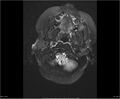 Brainstem glioma (Radiopaedia 21819-21775 Axial FLAIR 4).jpg