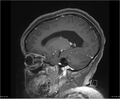 Brainstem glioma (Radiopaedia 21819-21775 D 29).jpg