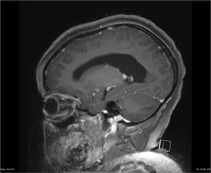 File:Brainstem glioma (Radiopaedia 21819-21775 D 29).jpg