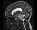 Brainstem glioma (Radiopaedia 21819-21775 Sagittal T2 10).jpg