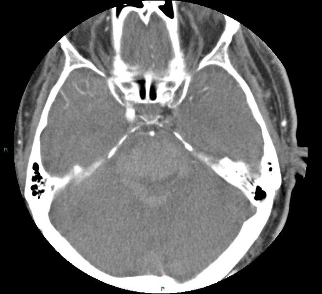 File:Brainstem hemorrhage (Radiopaedia 58794-66028 D 65).jpg