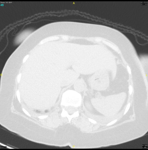 File:Breast primary with lung and bone metastases (Radiopaedia 40620-43228 Axial lung window 46).jpg