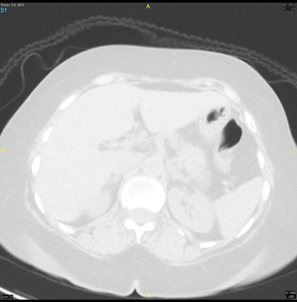 File:Breast primary with lung and bone metastases (Radiopaedia 40620-43228 Axial lung window 51).jpg