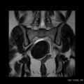 Broad ligament fibroid (Radiopaedia 49135-54241 Coronal T2 19).jpg