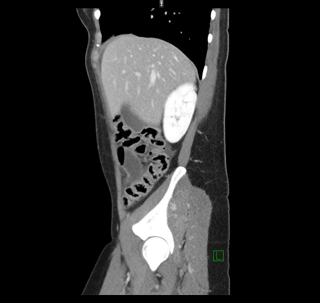 File:Broad ligament hernia (Radiopaedia 63260-71832 C 13).jpg
