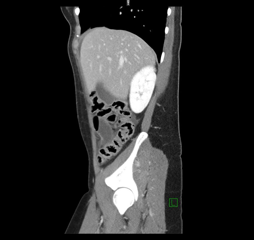 Broad ligament hernia (Radiopaedia 63260-71832 C 13).jpg