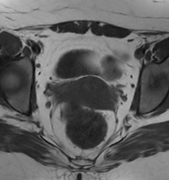 File:Broad ligament leiomyoma (Radiopaedia 81634-95516 Axial T1 16).jpg