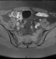 Broad ligament leiomyoma (Radiopaedia 81634-95516 Axial T1 fat sat 4).jpg