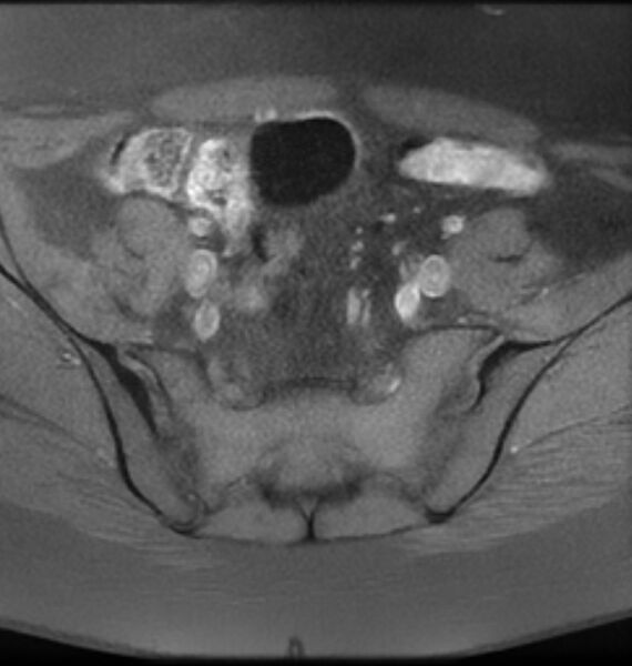 File:Broad ligament leiomyoma (Radiopaedia 81634-95516 Axial T1 fat sat 4).jpg
