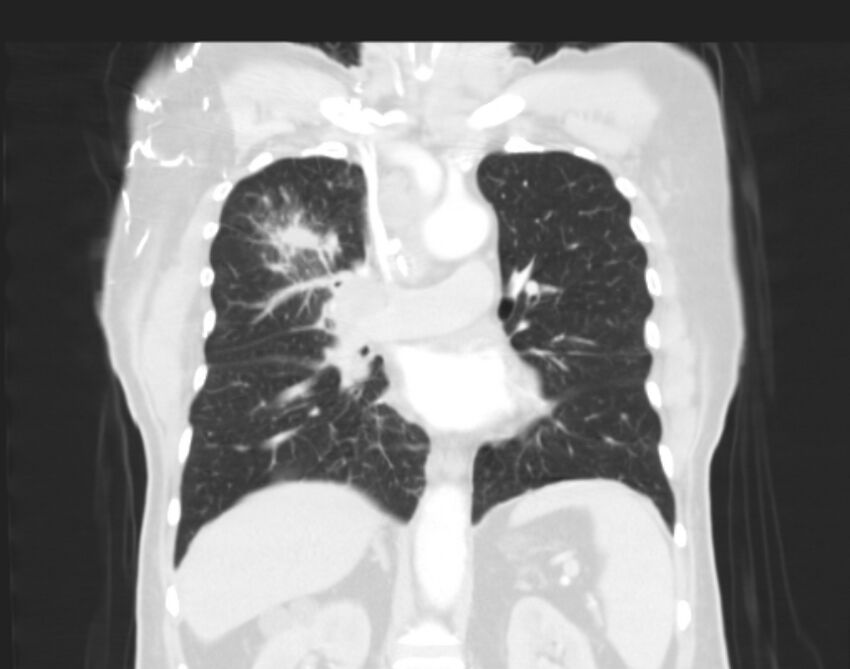Bronchogenic carcinoma with lymphangitic spread (Radiopaedia 29002-29357 Coronal lung window 34).jpg