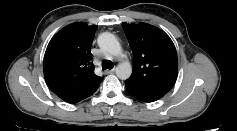 File:Bronchogenic carcinoma with superior vena cava syndrome (Radiopaedia 36497-38054 Axial C+ delayed 31).jpg