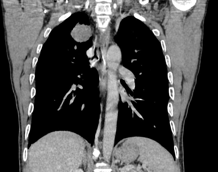 File:Bronchogenic carcinoma with superior vena cava syndrome (Radiopaedia 36497-38054 Coronal C+ delayed 67).jpg