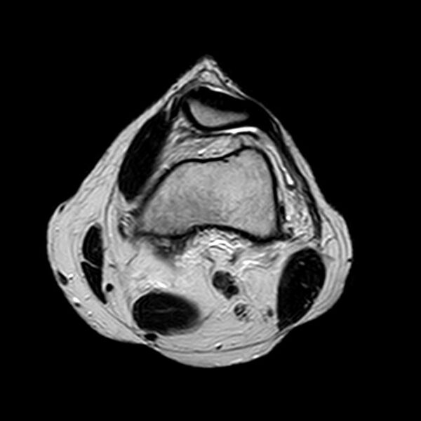 File:Bucket handle tear - medial meniscus (Radiopaedia 29250-29664 Axial T2 15).jpg