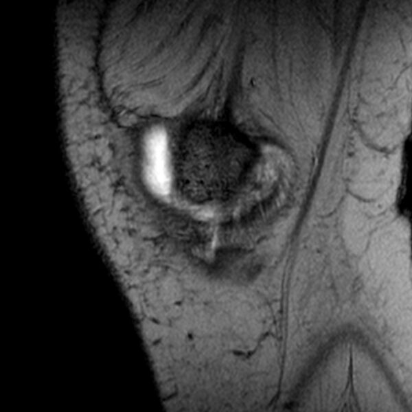 File:Bucket handle tear - medial meniscus (Radiopaedia 79028-91942 D 23).jpg