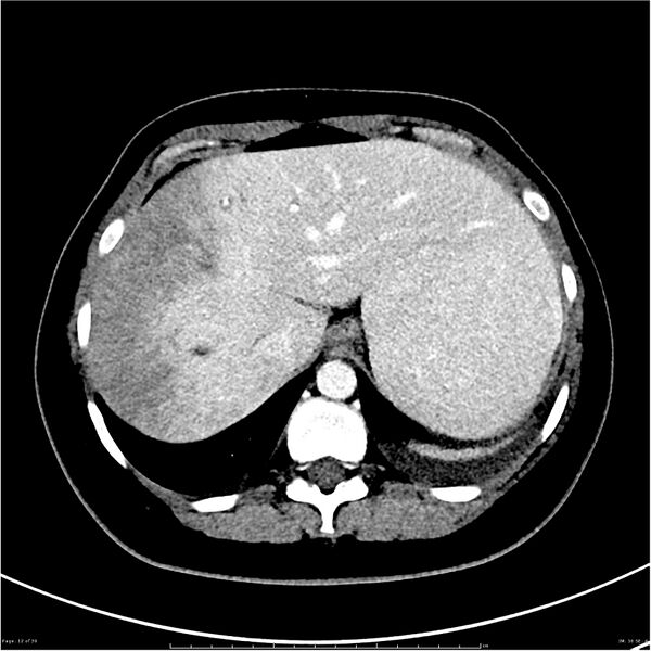 File:Budd-Chiari syndrome (Radiopaedia 27929-28177 Axial liver window 12).JPG