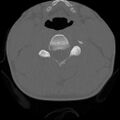 C5 facet fracture (Radiopaedia 58374-65499 Axial bone window 48).jpg