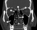 CT sinuses (anatomy quiz) (Radiopaedia 60519).jpg