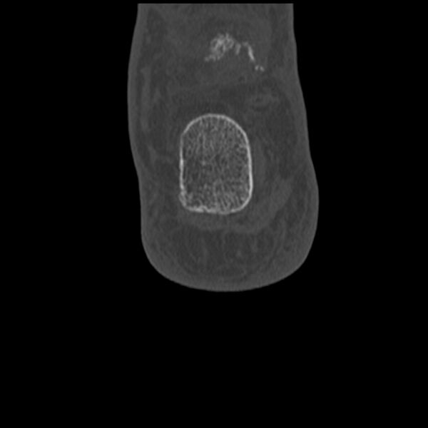 File:Calcaneal tuberosity avulsion fracture (Radiopaedia 22649-22668 Coronal bone window 61).jpg