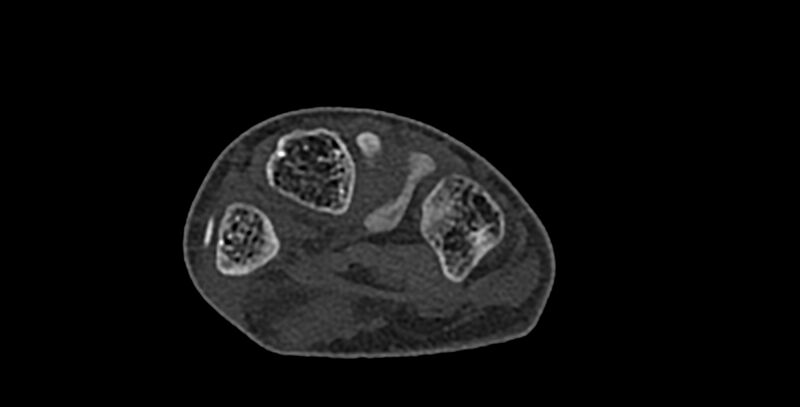 File:Calcifying aponeurotic fibroma (Radiopaedia 88423-105064 Axial bone window 114).jpg