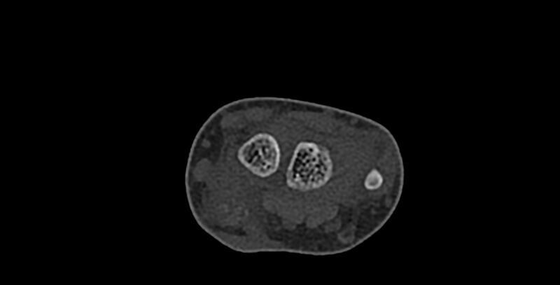 File:Calcifying aponeurotic fibroma (Radiopaedia 88423-105064 Axial bone window 48).jpg