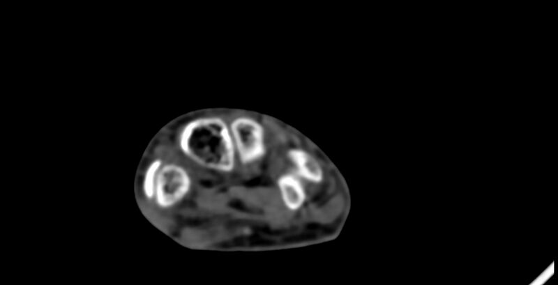 File:Calcifying aponeurotic fibroma (Radiopaedia 88423-105064 B 118).jpg