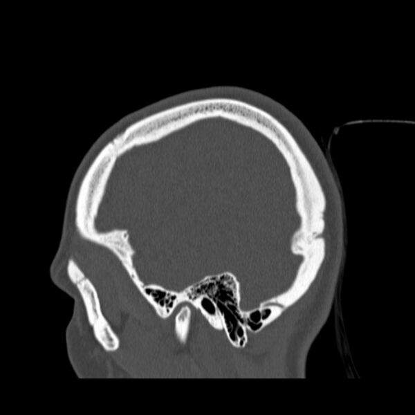 File:Calvarial osteoma (Radiopaedia 36520-38079 Sagittal bone window 21).jpg