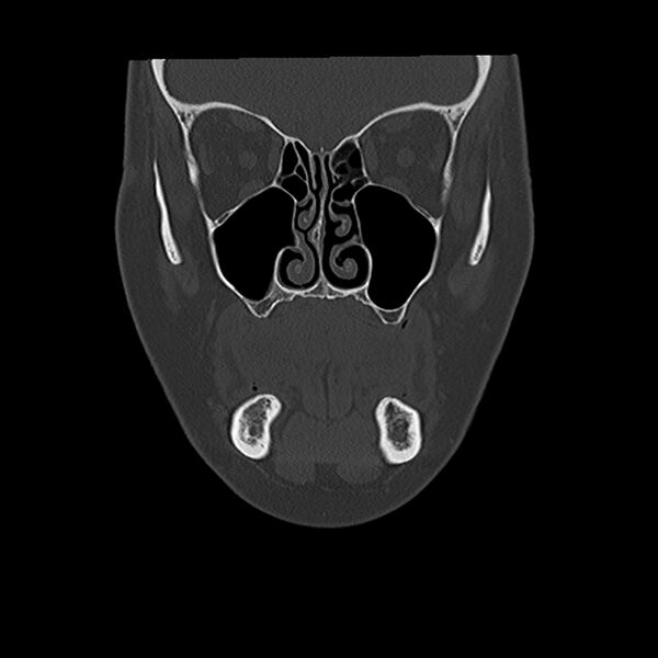 File:Canal up mastoidectomy (Radiopaedia 78108-90638 Coronal bone window 7).jpg