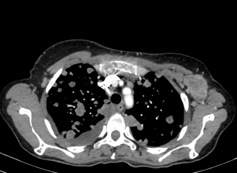 File:Cannonball metastases from breast cancer (Radiopaedia 91024-108569 A 33).jpg