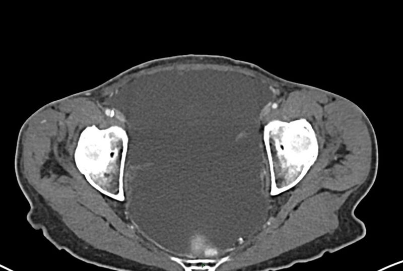File:Carcinoid mesenteric tumor complicated by chylous ascites (Radiopaedia 76312-87953 A 71).jpg