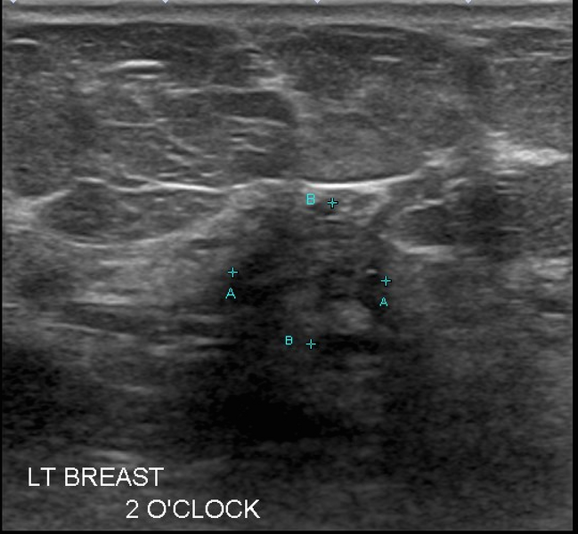 File:Carcinoma left breast (Radiopaedia 30017-30574 A 1).png