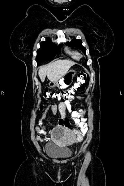File:Carcinoma of uterine cervix (Radiopaedia 85861-101700 C 5).jpg