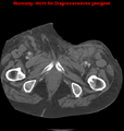 Cardiac perforation following transcatheter aortic valve implantation (Radiopaedia 23714-23863 B 16).png