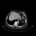 Carotid body tumor (Radiopaedia 21021-20948 B 54).jpg