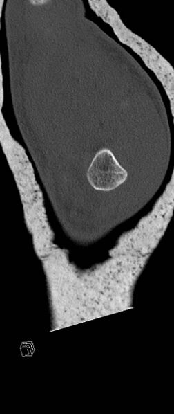 File:Carpal fractures (smart watch impaction) (Radiopaedia 55844-62430 Sagittal bone window 43).jpg