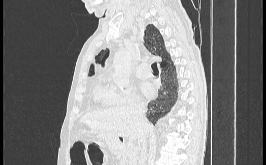 Cavitating bronchogenic carcinoma (Radiopaedia 44489-48162 Sagittal lung window 25).jpg
