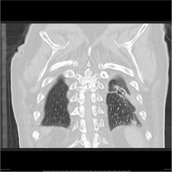 File:Cavitating left lower lobe lesion - squamous cell lung cancer (Radiopaedia 27749-28176 Coronal lung window 49).jpg