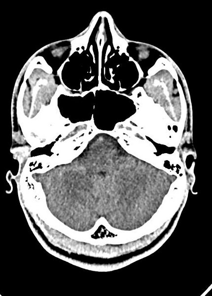 File:Cavum septum pellucidum and cavum vergae (Radiopaedia 77797-90060 Axial Brain Window 23).jpg