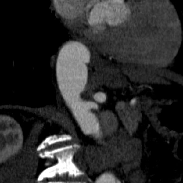 File:Celiac artery aneurysm (Radiopaedia 21574-21525 B 3).JPEG