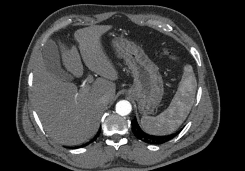 File:Celiac artery dissection (Radiopaedia 52194-58080 A 12).jpg