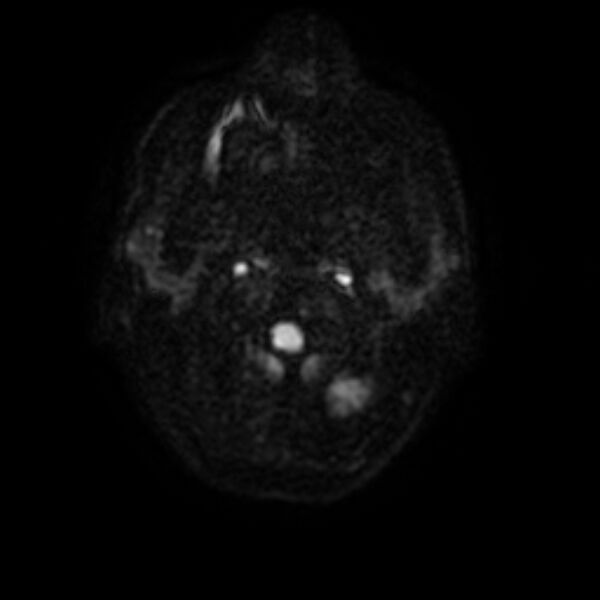 File:Central neurocytoma (Radiopaedia 67618-77021 Axial DWI 1).jpg