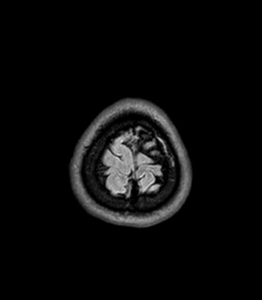 File:Central neurocytoma (Radiopaedia 79320-92380 Axial FLAIR 40).jpg