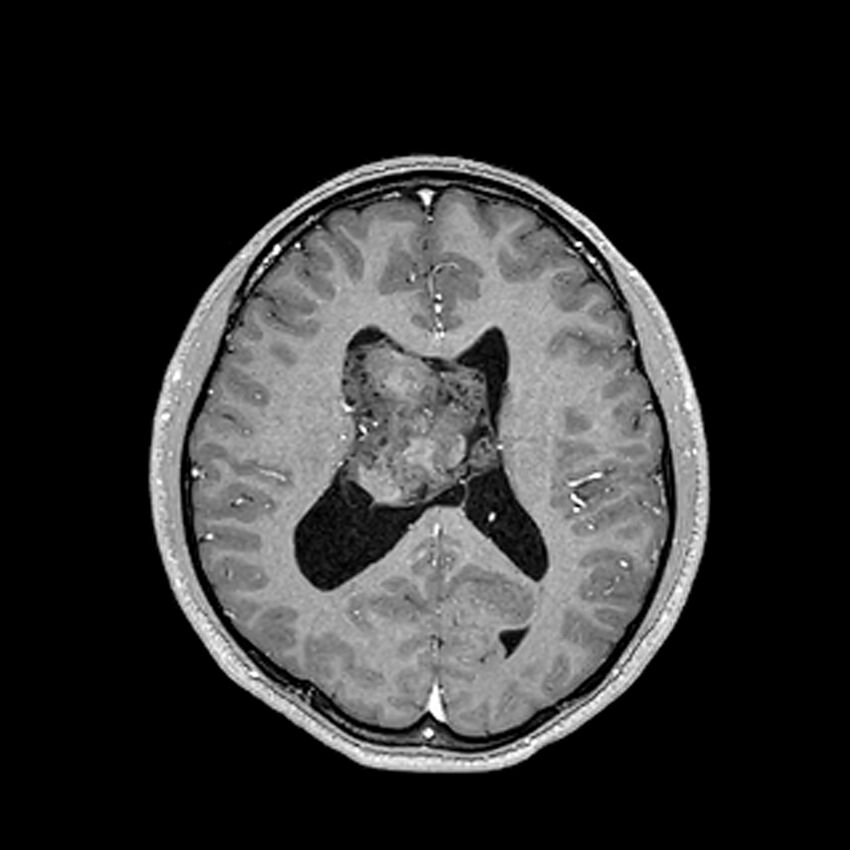 Central neurocytoma (Radiopaedia 79320-92380 Axial T1 C+ 149).jpg