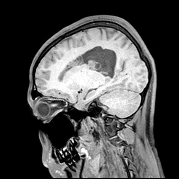 File:Central neurocytoma (Radiopaedia 79320-92380 Sagittal T1 169).jpg