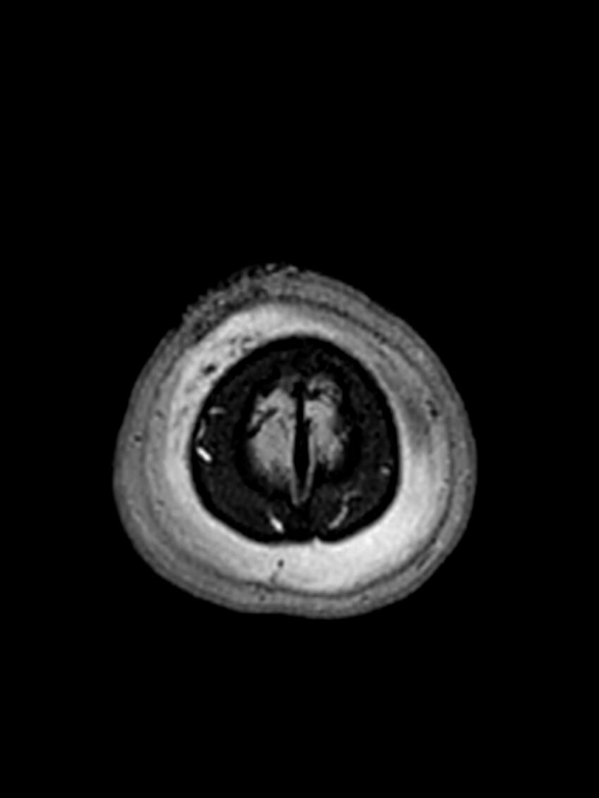 Central neurocytoma (Radiopaedia 79320-92381 Axial FLAIR 24).jpg
