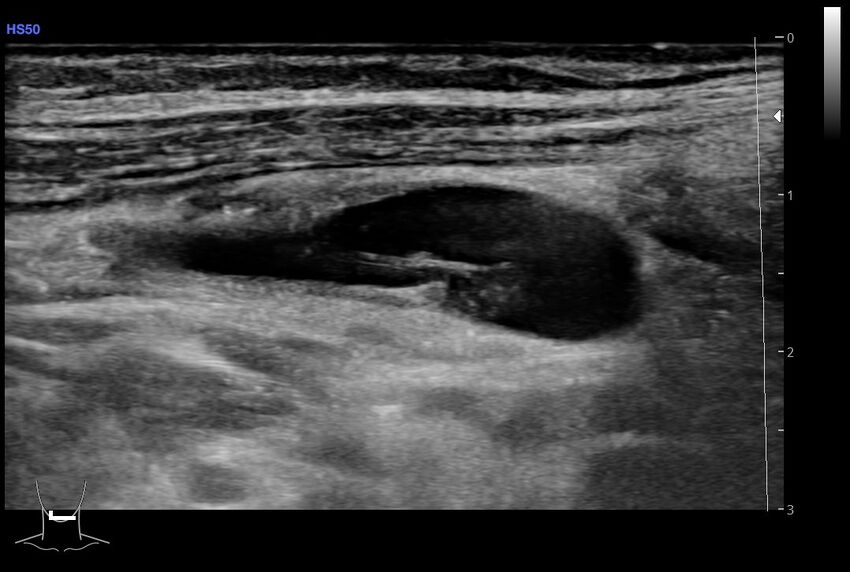 Central venous catheter-related thrombosis (Radiopaedia 61135-69025 Longitudinal 53).jpg