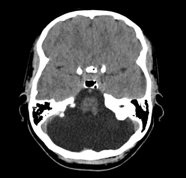 File:Cerebellar agenesis (Radiopaedia 30203-30817 Axial non-contrast 12).jpg